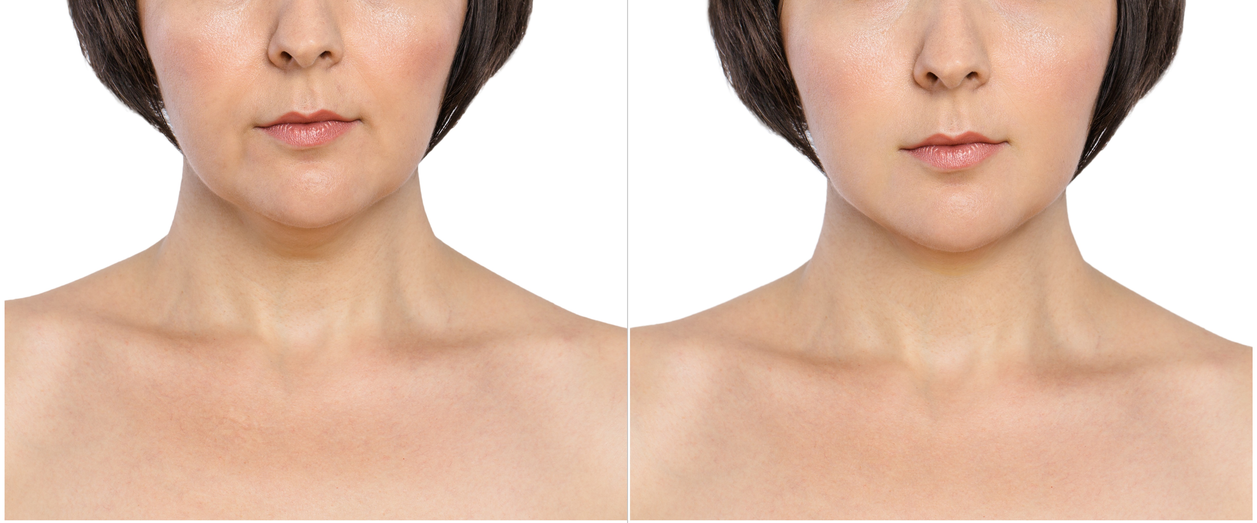 The Benefits of Kybella - Best place to get Kybella in Santa Monica